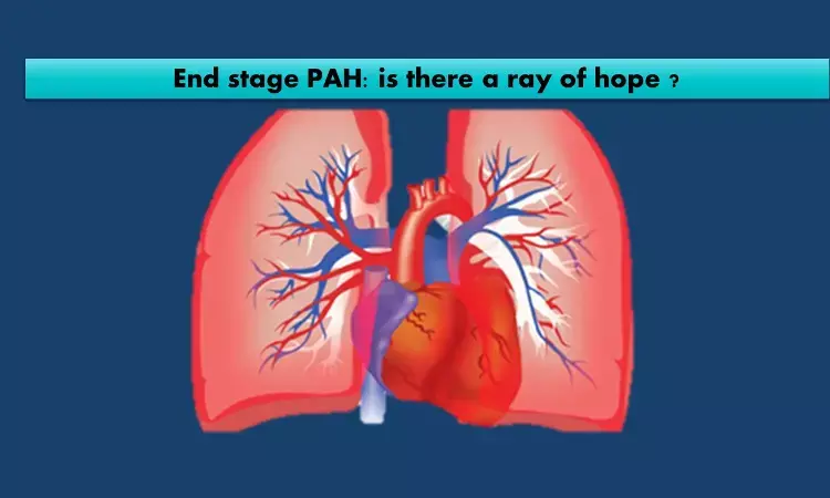 Ray of hope for end stage pulmonary hypertension: Potts shunt