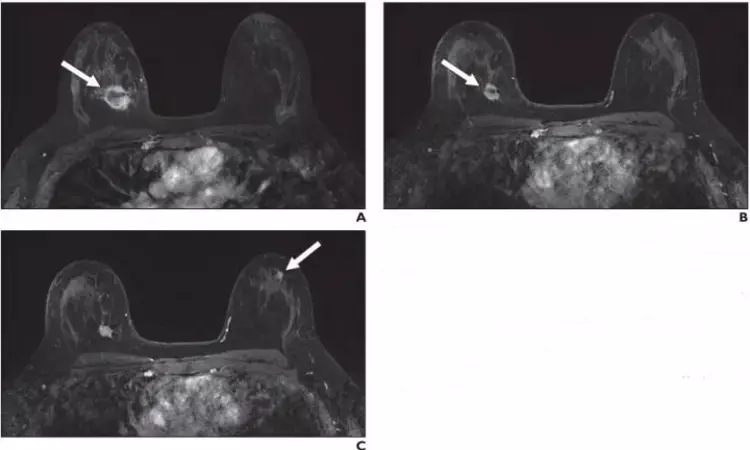 New suspicious lesions on breast MRI in neoadjuvant therapy not malignant