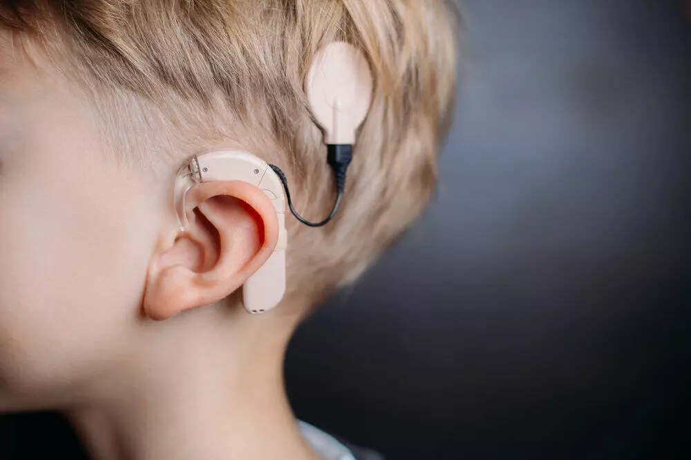 Cochlear Implant in Deaf Children with Autism Can Improve Language Skills and Social Engagement