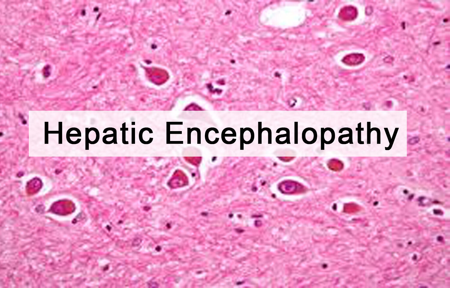 Rifaximin And Hepatic Encephalopathy