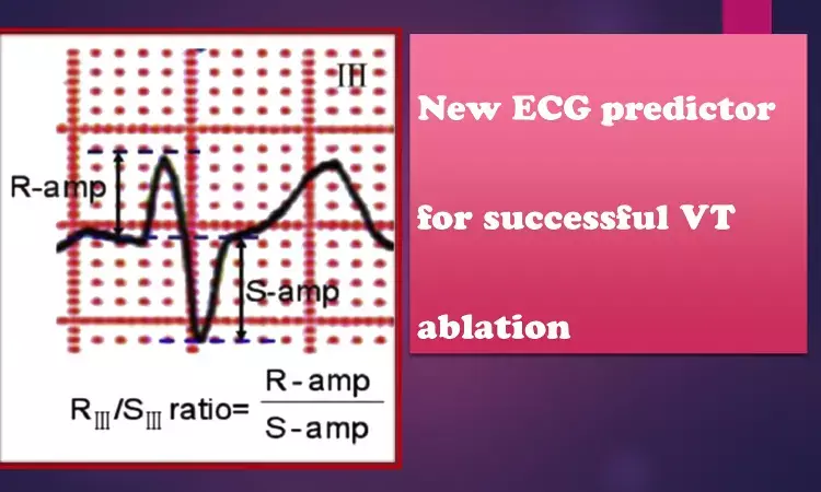 A Simple ECG predictor for successful para-Hisian VT ablation