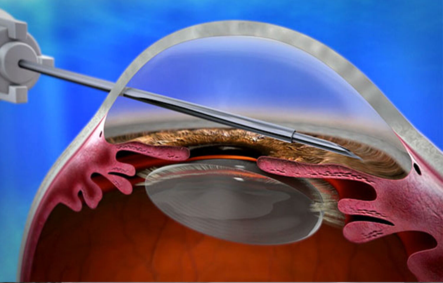 Больница операция глаукомы. Парацентез передней камеры глаза. Хирургия врожденной глаукомы.
