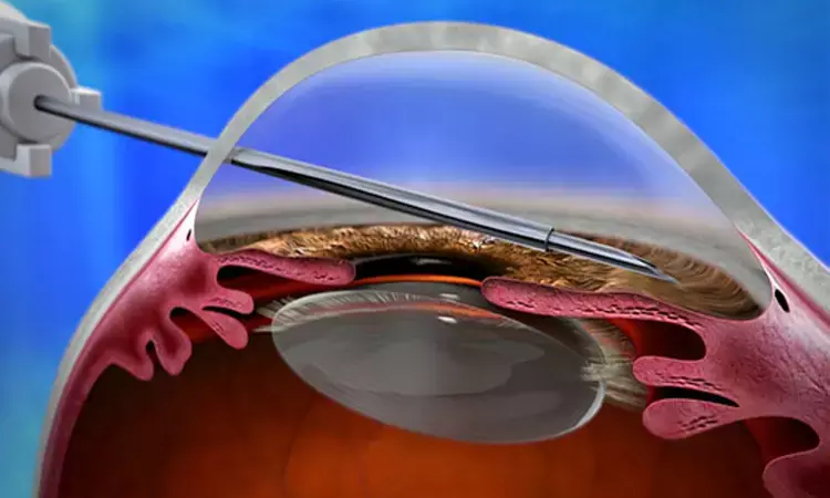 Xen45 gel stent implant a viable option for glaucoma control Post failed trabeculectomy