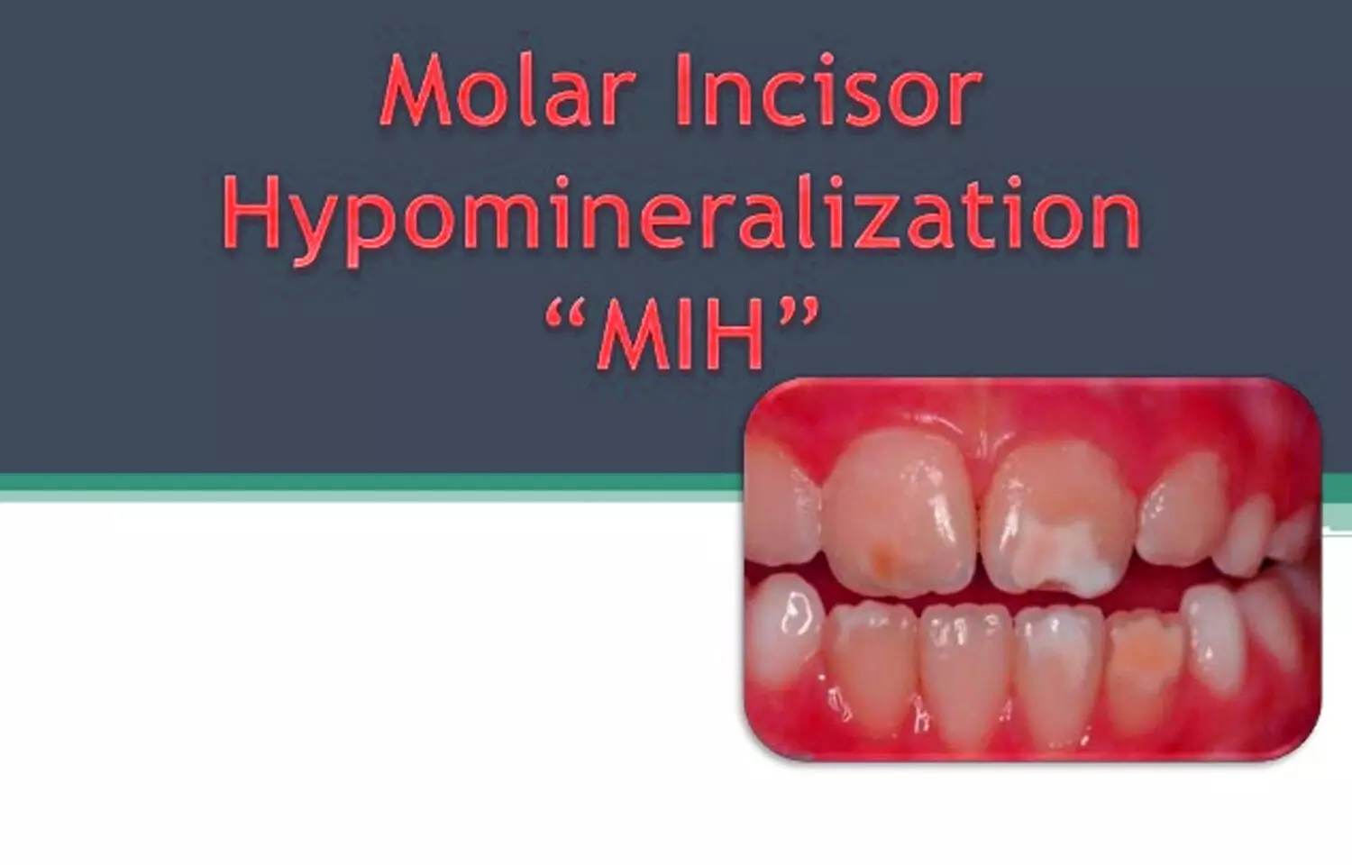 Management of MIH to prevent early posteruptive enamel breakdown- A case report