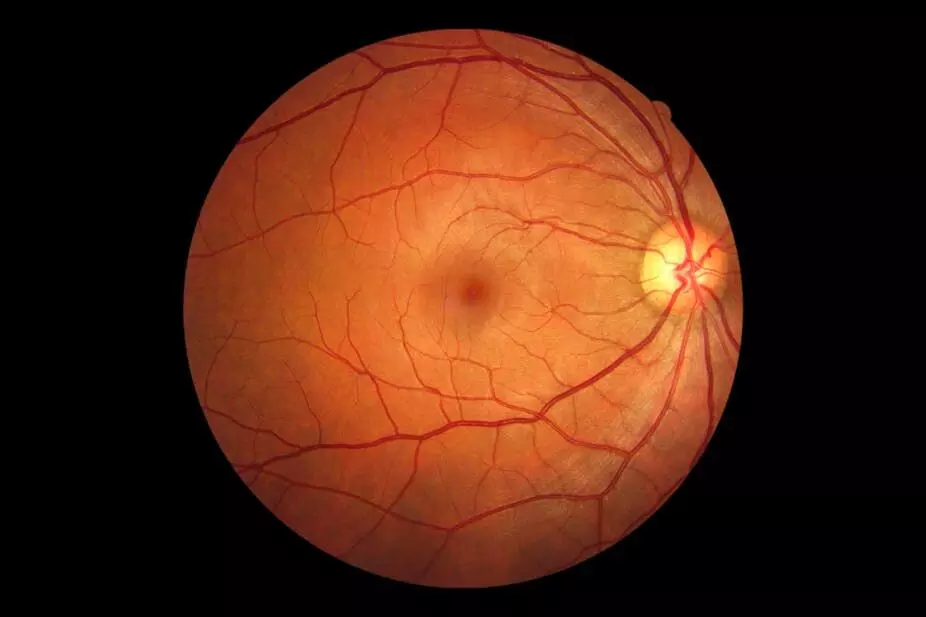 Decreased retinal nerve thickness predicts risk for clinically progressive depression: JAMA Study