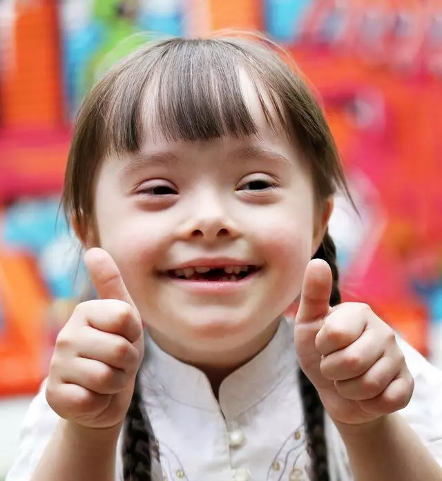 Arytenoid obstruction in children with Downs syndrome tied to adenotonsillectomy failure: JAMA