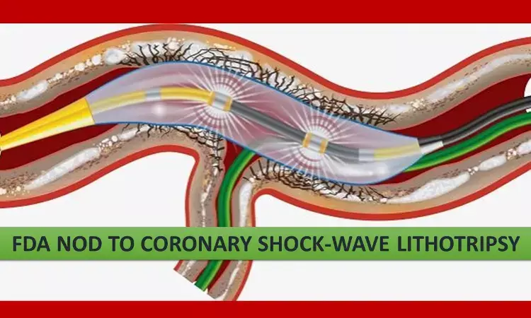 Shock-wave lithotripsy gets FDA approval