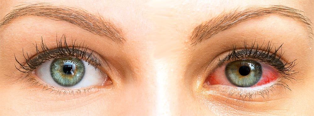 Tear secretions from lacrimal gland differ in normal versus dry eyes