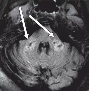 COVID-19 associated with leukoencephalopathy on brain MRI