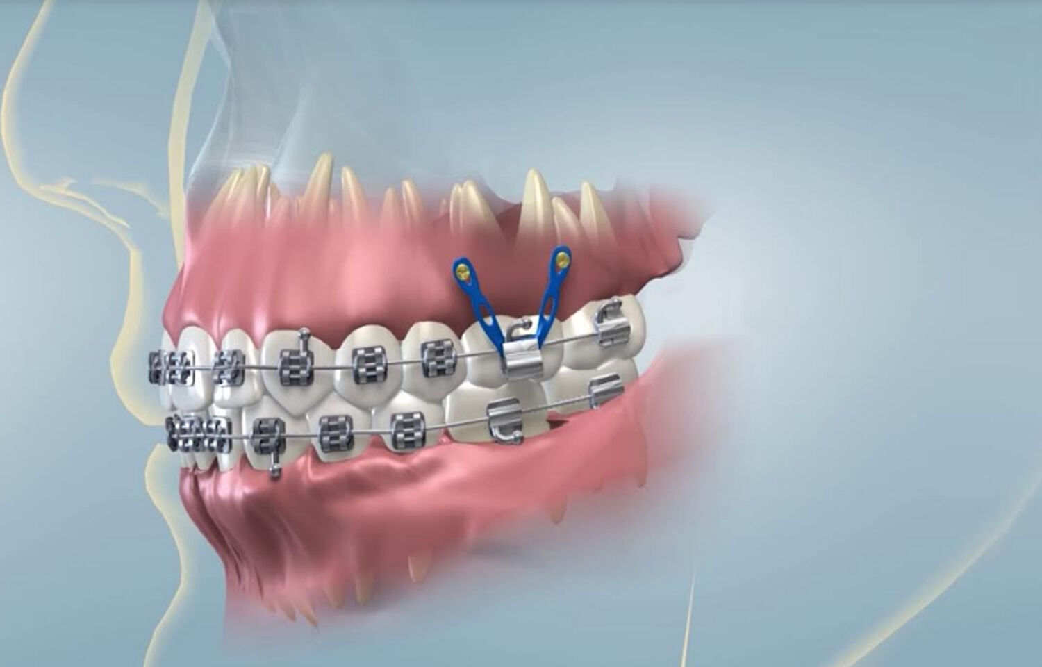 Spontaneous repair of iatrogenic root perforation by an orthodontic ...