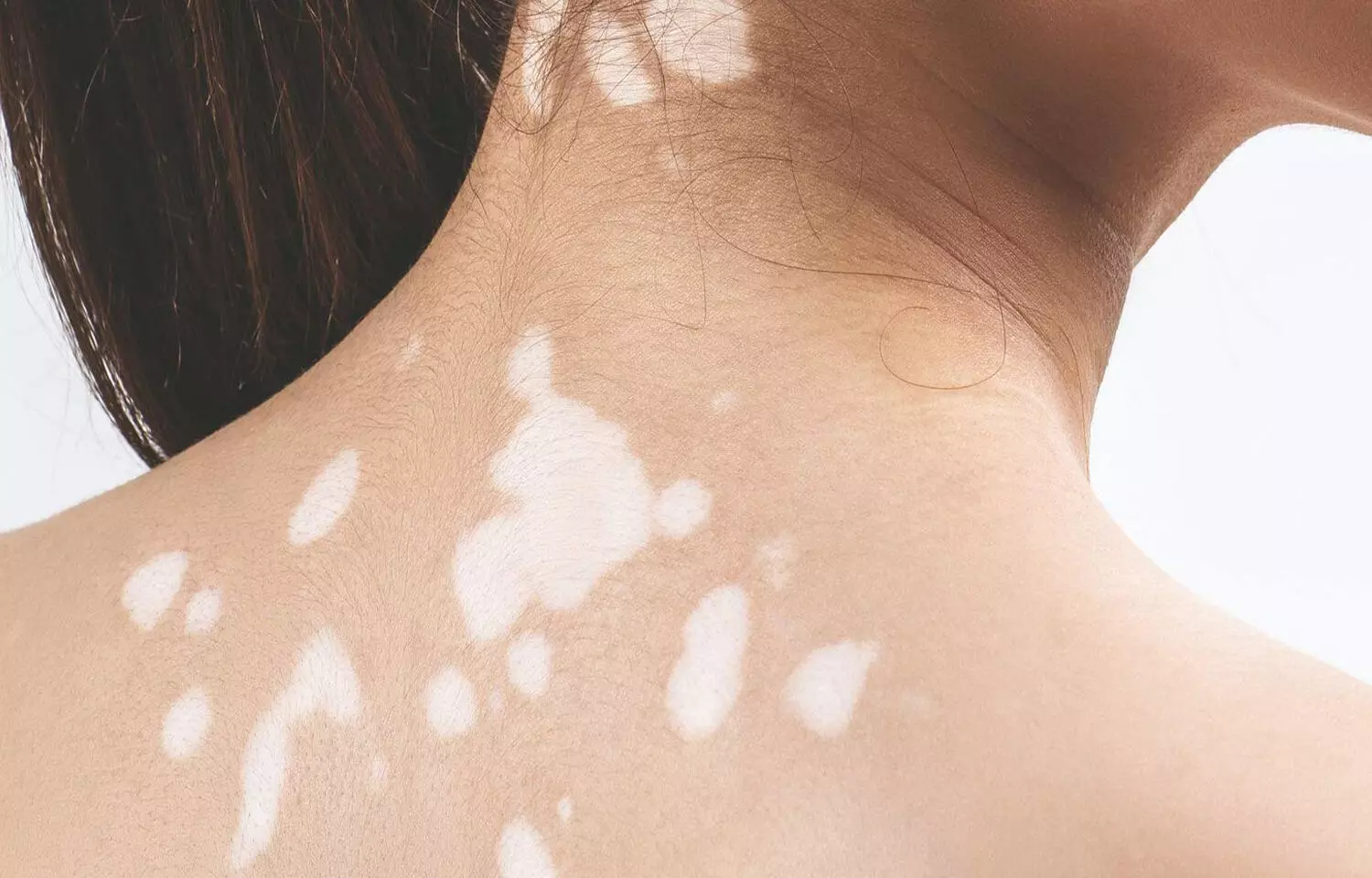 Ultraviolet light and methotrexate combo effective for vitiligo management: Study