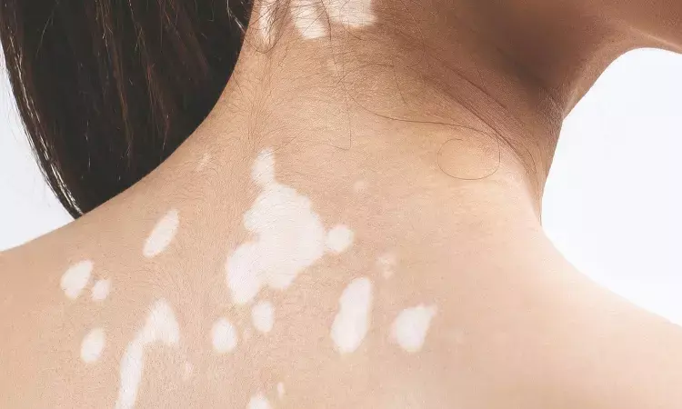 Ruxolitinib Cream shows positive results in patients with Vitiligo
