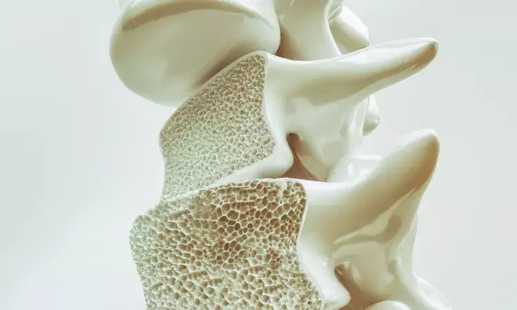 Osteoporosis increases mortality risk in patients with bronchiectasis: BMC