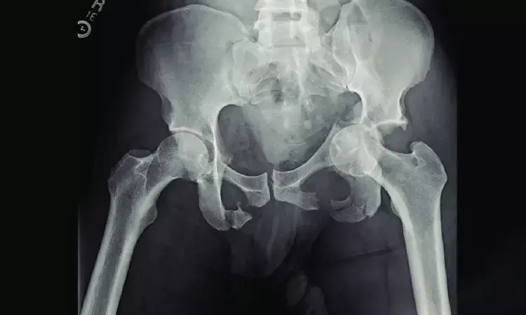 Pelvic bone loss may contribute to pelvic stress fracture after hip replacement surgery
