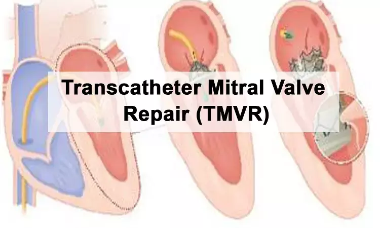 Rare Transcatheter Mitral valve-in-valve implantation performed on 78 year old at Aster RV Hospital