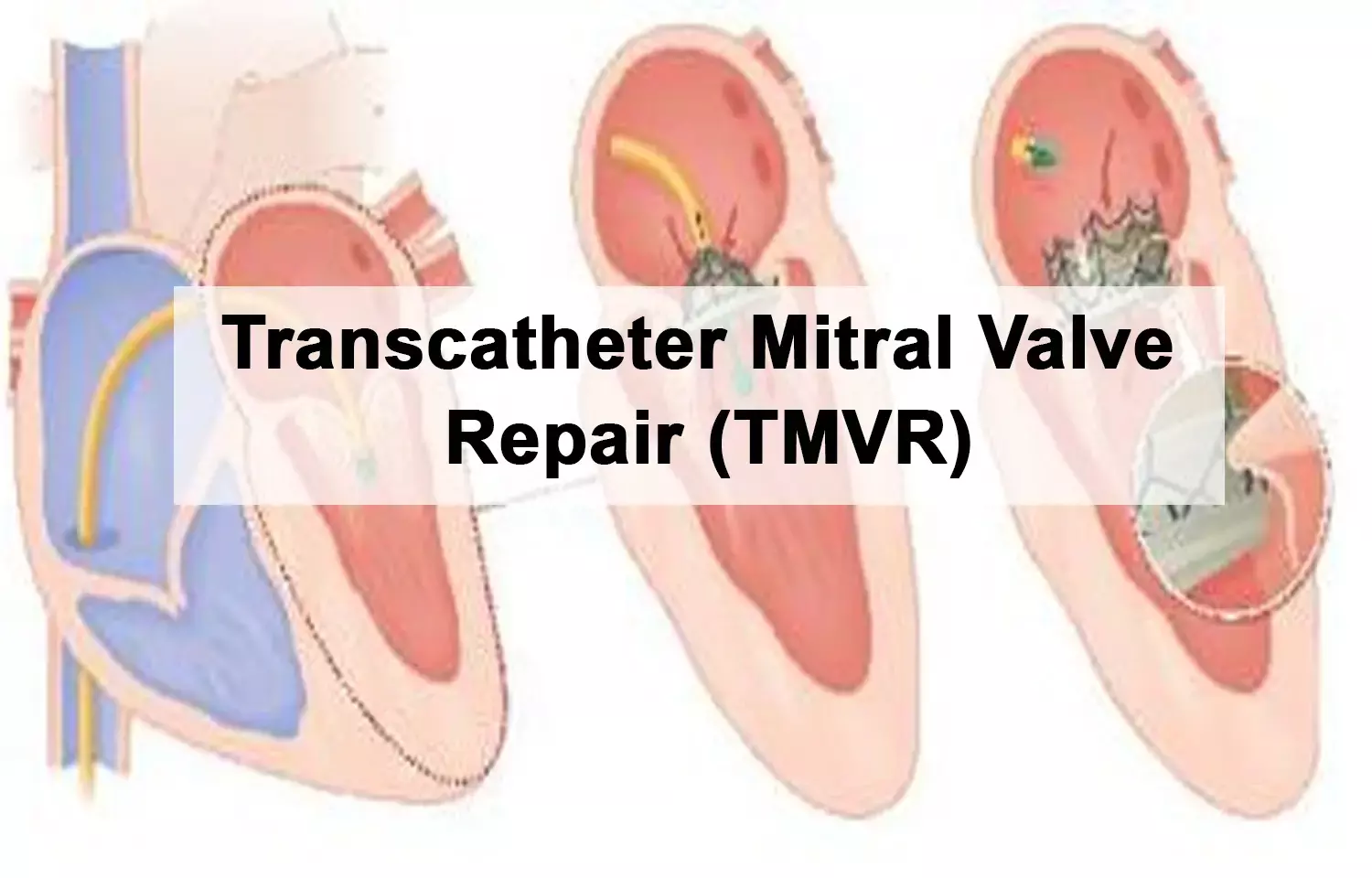 Transcatheter Mitral Valve Repair (TMVR)