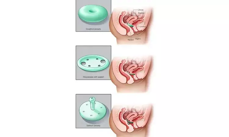 Vaginal pessaries safe and simple solution for pelvic organ prolapse: Study