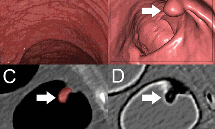 Expert Systems Help Identify Benign and Precancerous Colorectal Polyps on CT