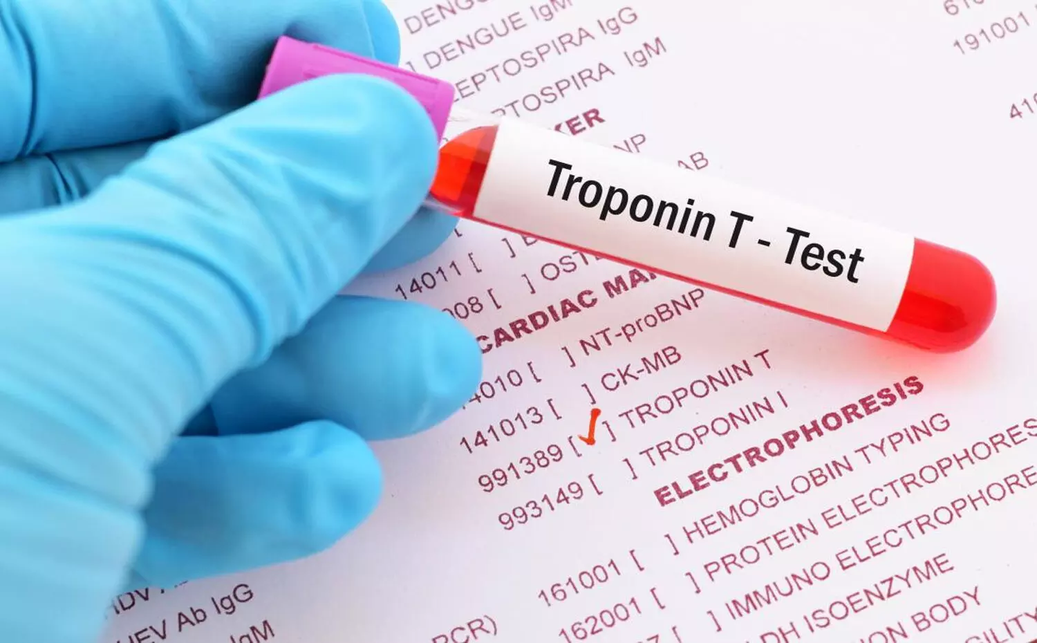 Single high-sensitivity cardiac troponin T reading can safely exclude MI in ED