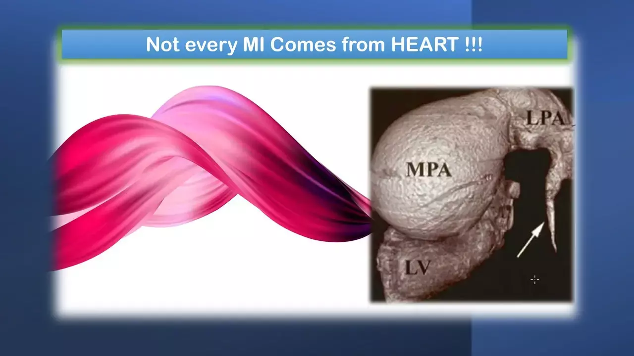 Thinking outside the heart -a rare case report of MI with extrinsic coronary compression. Thinking outside the heart -a rare case report of MI with extrinsic coronary compression.