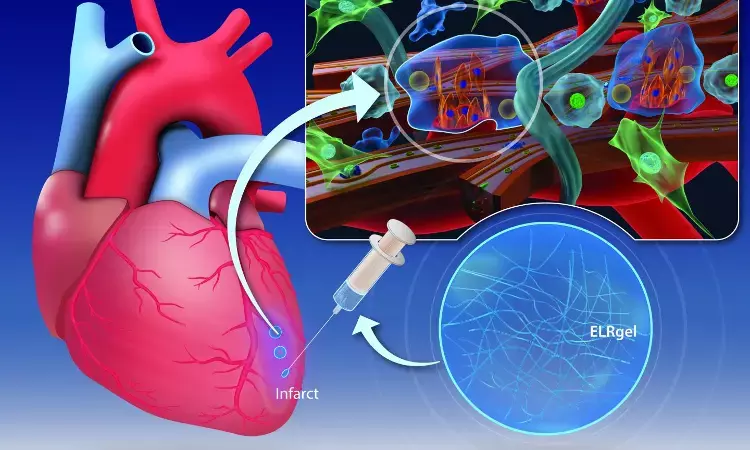 Hydrogel injection may change the way the heart muscle heals after a heart attack