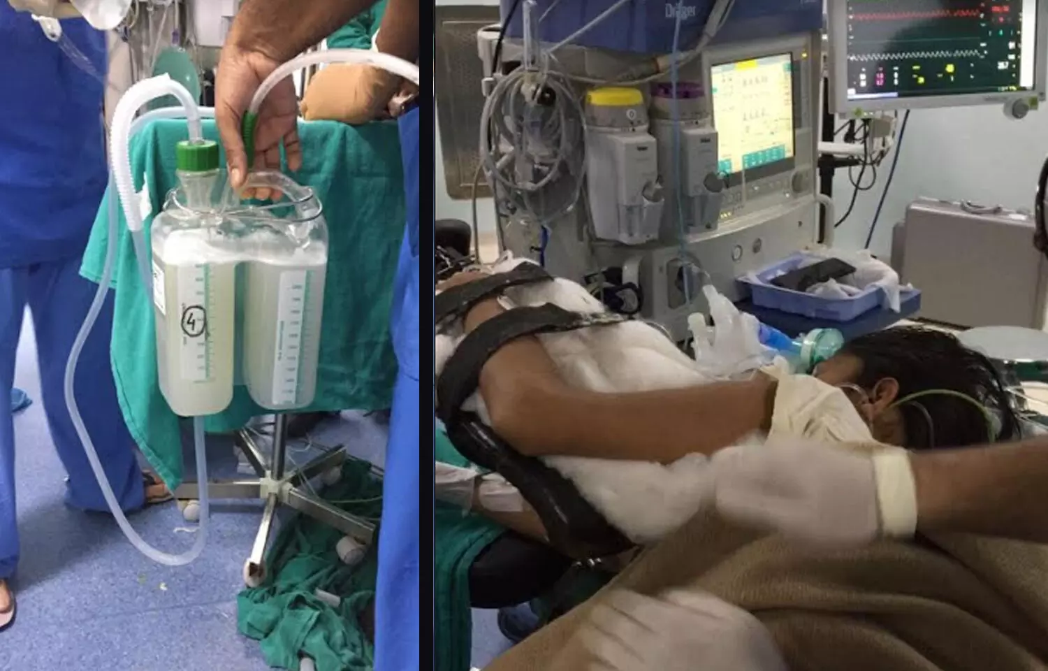 AIIMS Bhubaneswar doctors conduct complex Whole Lung Lavage procedure to remove unwanted protein from patient lungs