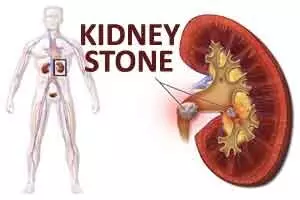 Researcher finds a promising new target for kidney stones and UTIs