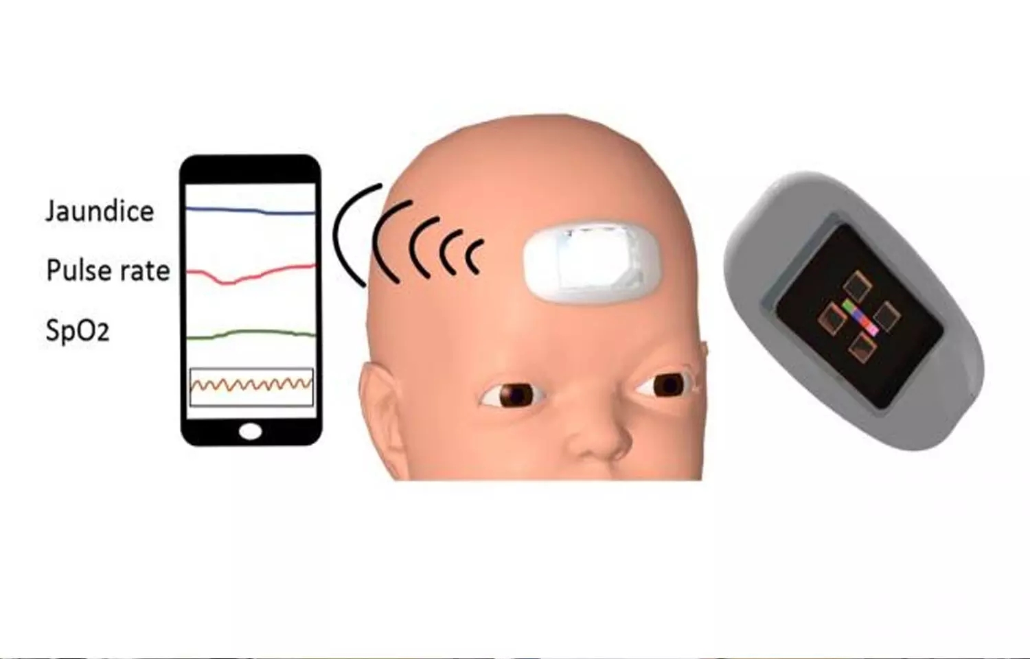 First wearable device can monitor  bilirubin and vitals in newborns: Study