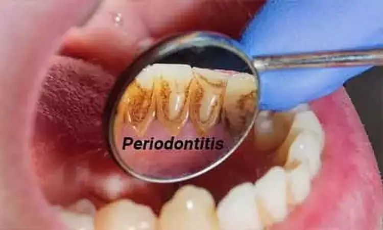 Periodontitis - A modifiable risk factor for Atrial Fibrillation, finds study