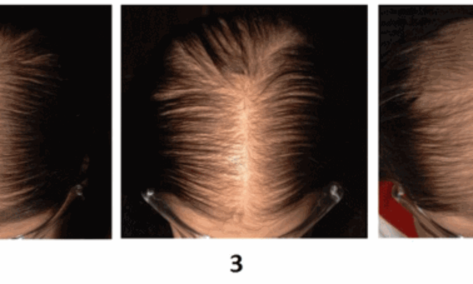Hair Loss in Women  NEJM