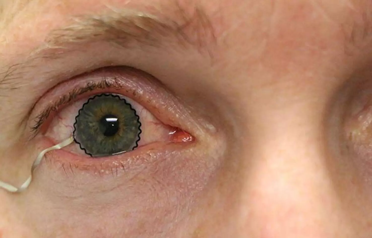 Posterior Subtenon Interferon Alfa-2B Resolves Refractory Ocular Fluid in central macular thickness, Suggests Study