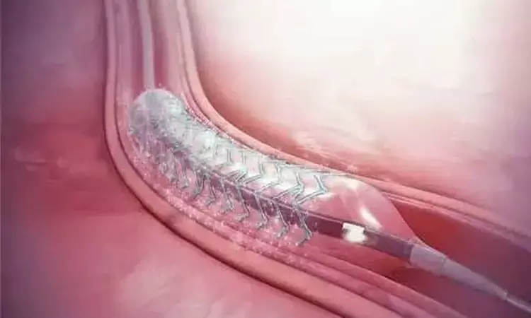 NPPA fixes ceiling price of two coronary stents