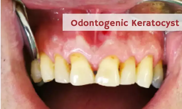 Unusual Case of Odontogenic Keratocyst with Atypical and Aggressive Behavior