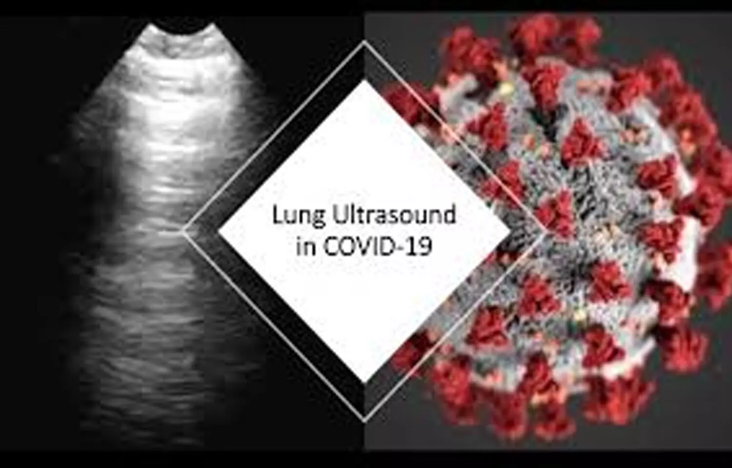 Lung ultrasound convenient for spotting COVID-19 in neonates