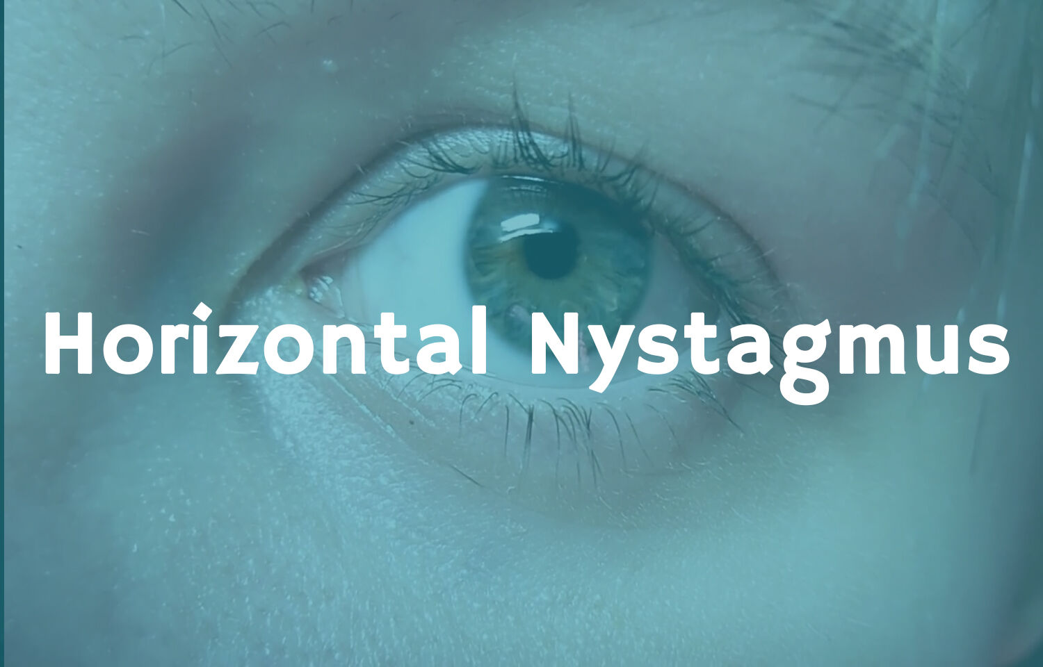 horizontal-nystagmus-is-gravity-dependent-in-patients-with-vestibular