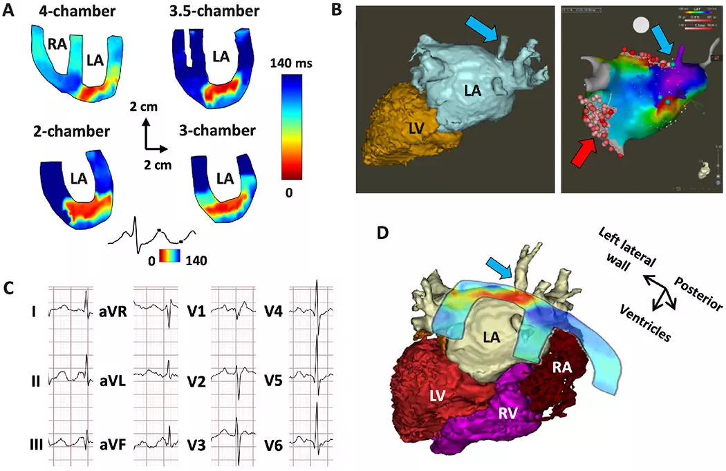Novel Imaging Method Locates Cardiac Arrhythmias, Finds Study