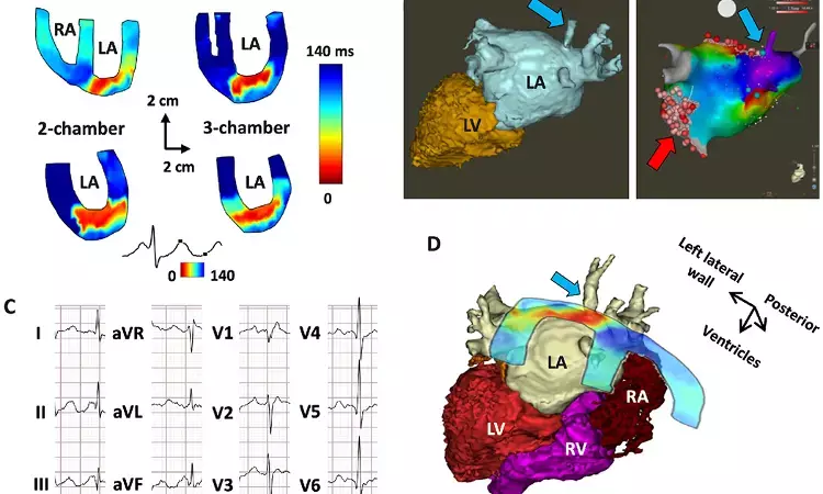 Novel Imaging Method Locates Cardiac Arrhythmias, Finds Study
