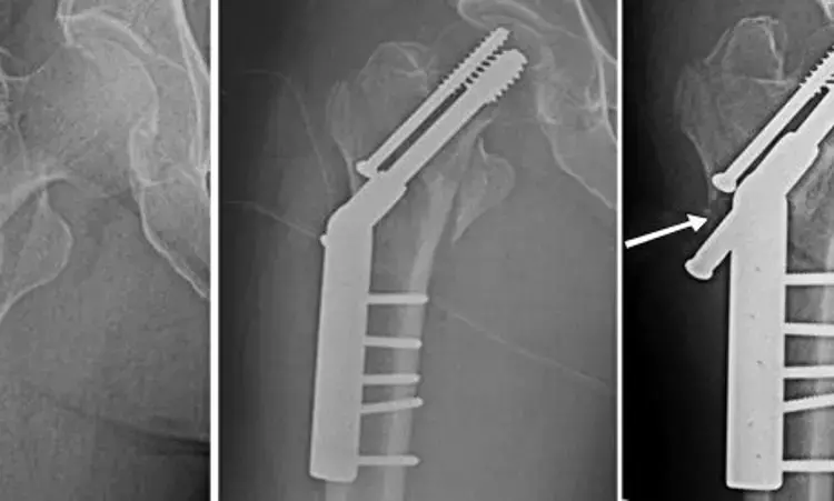 Intramedullary Fixation of Intertrochanteric fracture not tied to Hidden Blood Loss in Elderly