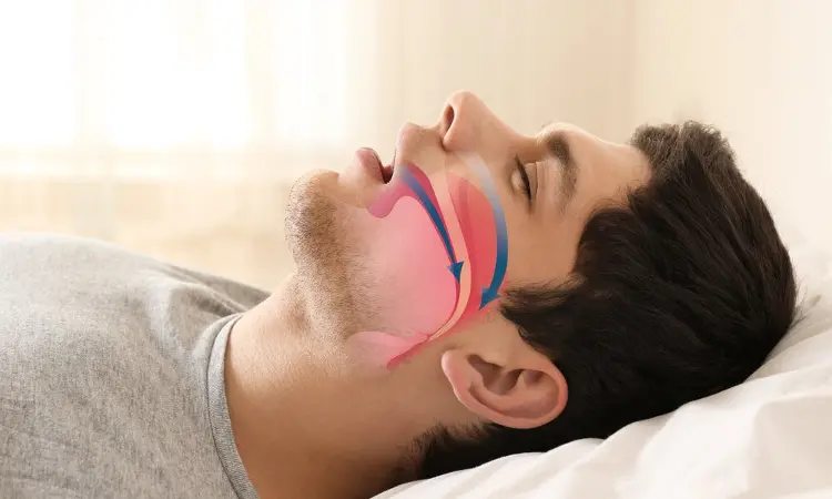 Medical treatment may improve sleep apnea syndrome due to non acid GERD: Case report