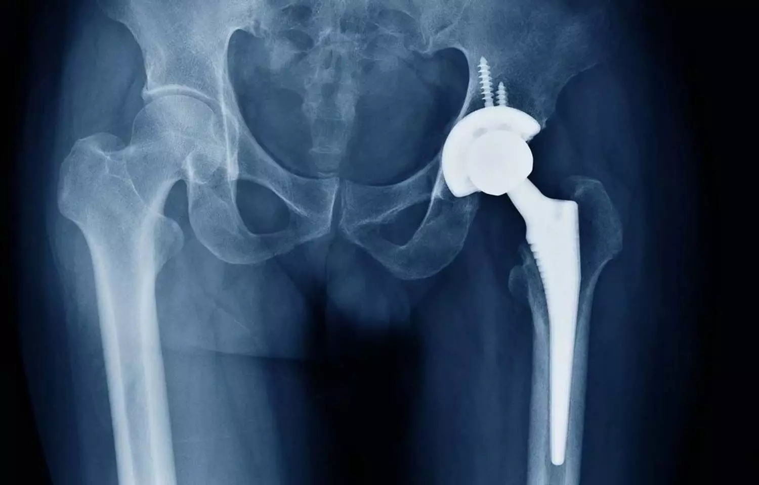 Preoperative factors may predict severity of BMD loss after hip replacement: Study