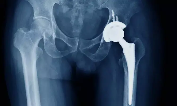 Following total hip replacement, septic hip arthritis linked to higher risk of periprosthetic joint infection