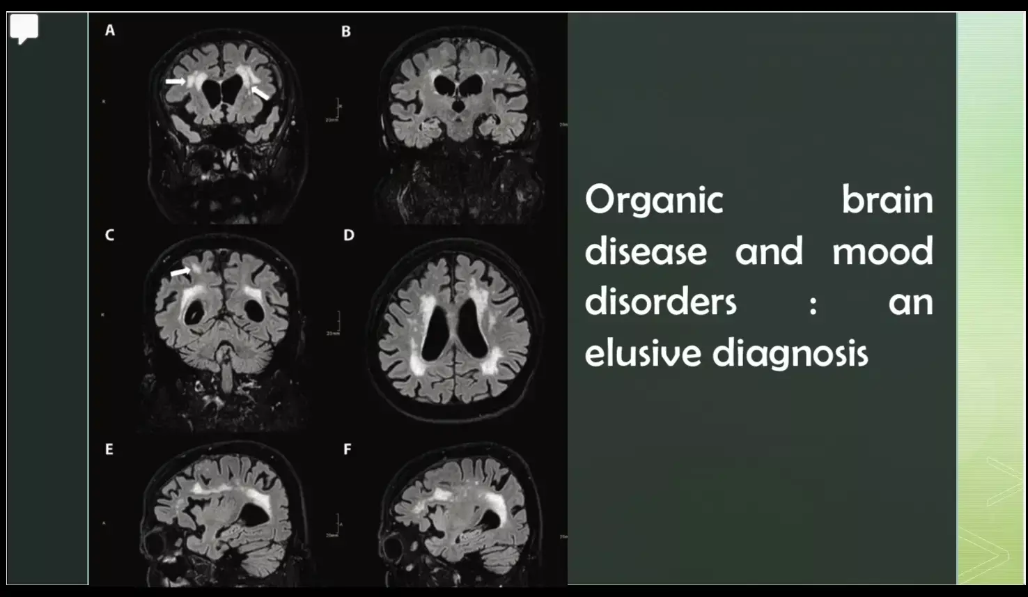 Mixed mood disorder secondary to Binswanger syndrome: a rare case report