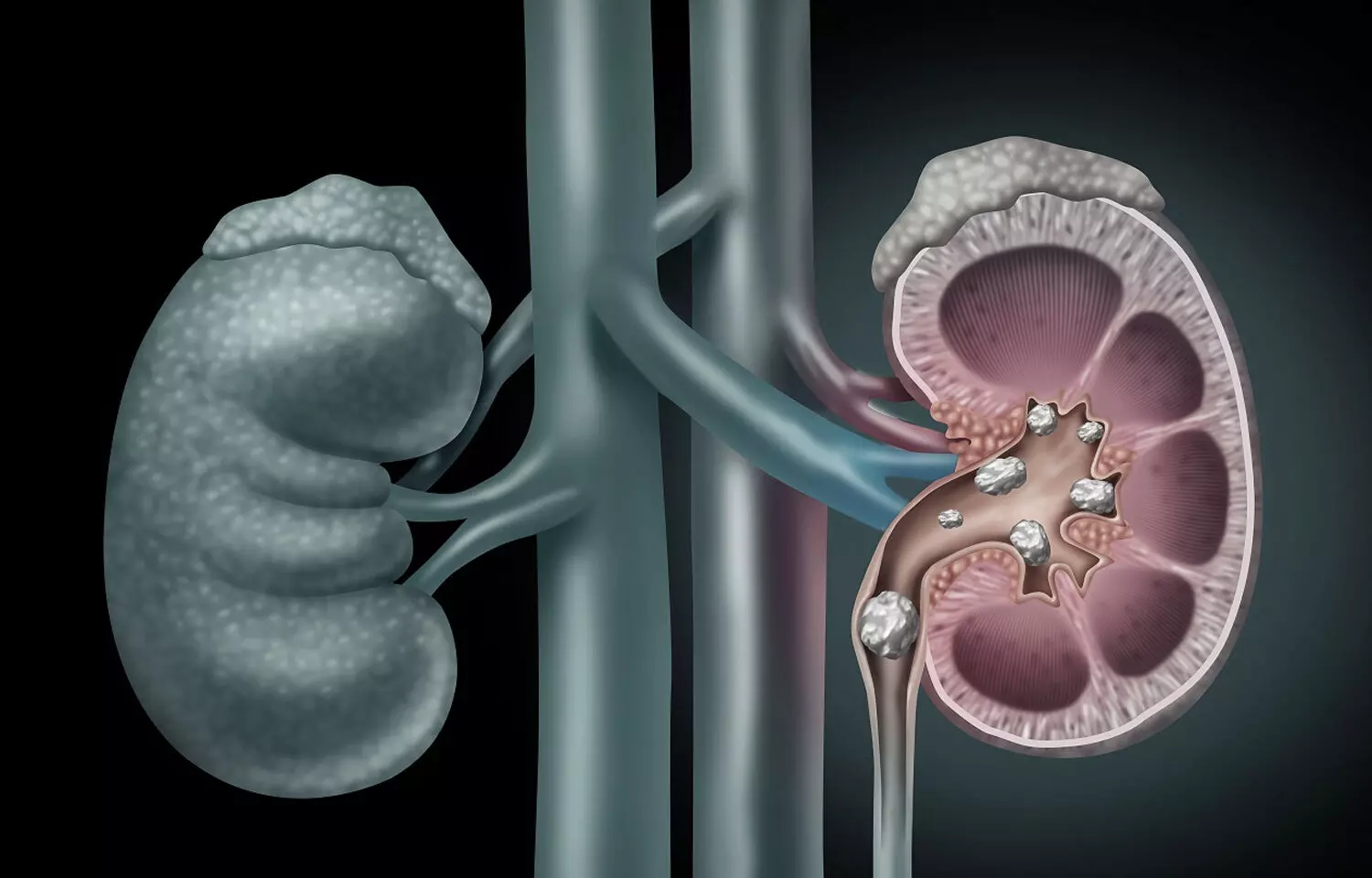 Lumasiran reduces kidney failure risk in primary hyperoxaluria type 1 patients: NEJM