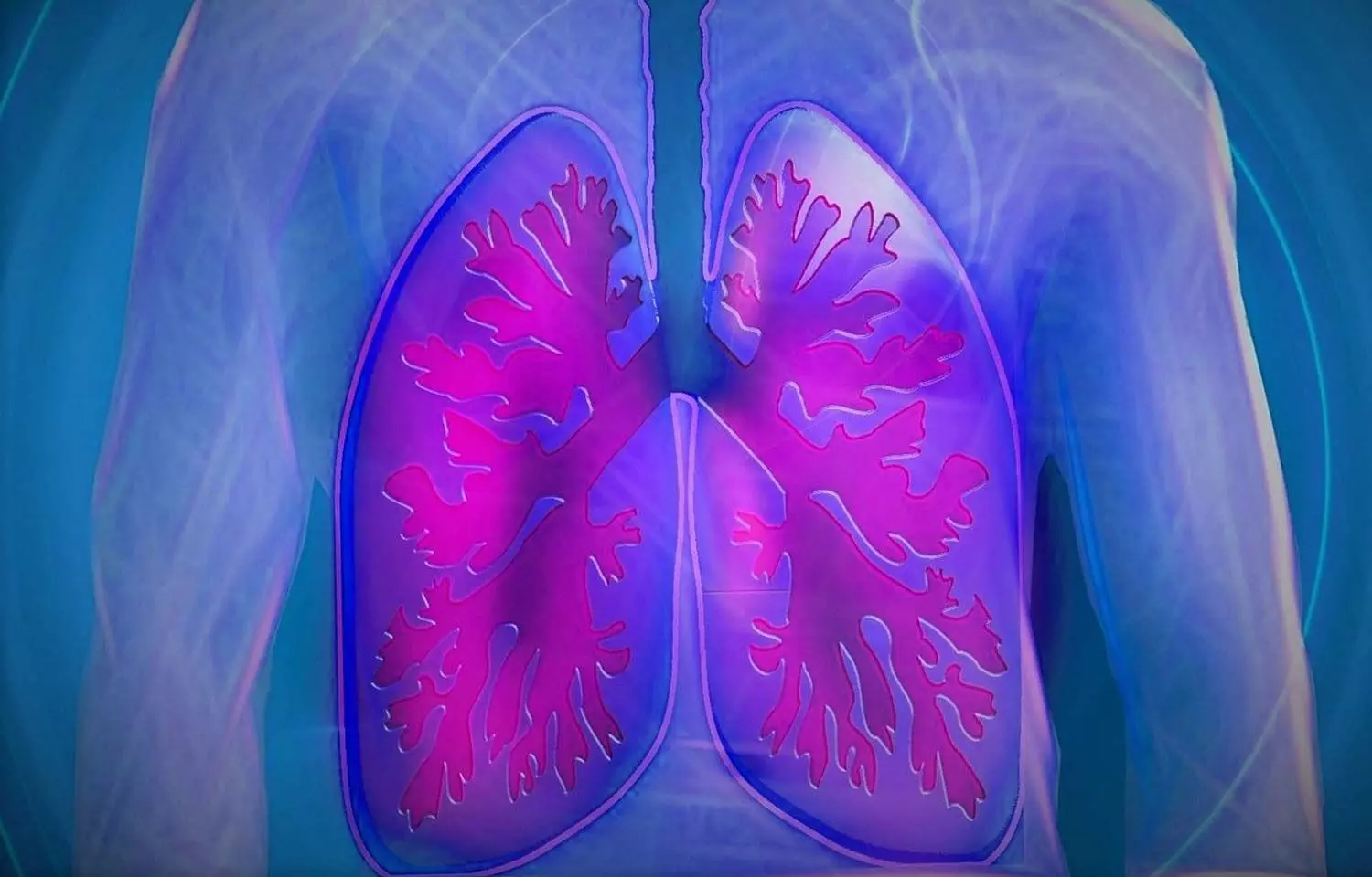 Fibrotic Lung abnormalities persist even after 1 year in severe COVID-19 survivors: Study