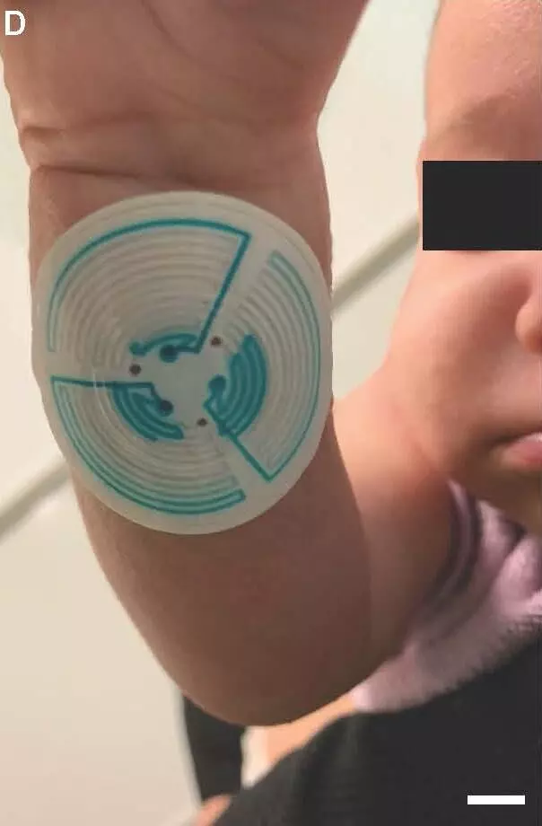 New Soft sweat stickers may streamline diagnosis of cystic fibrosis in children