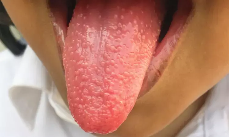 Case of Strawberry Tongue in Streptococcal Pharyngitis reported in NEJM