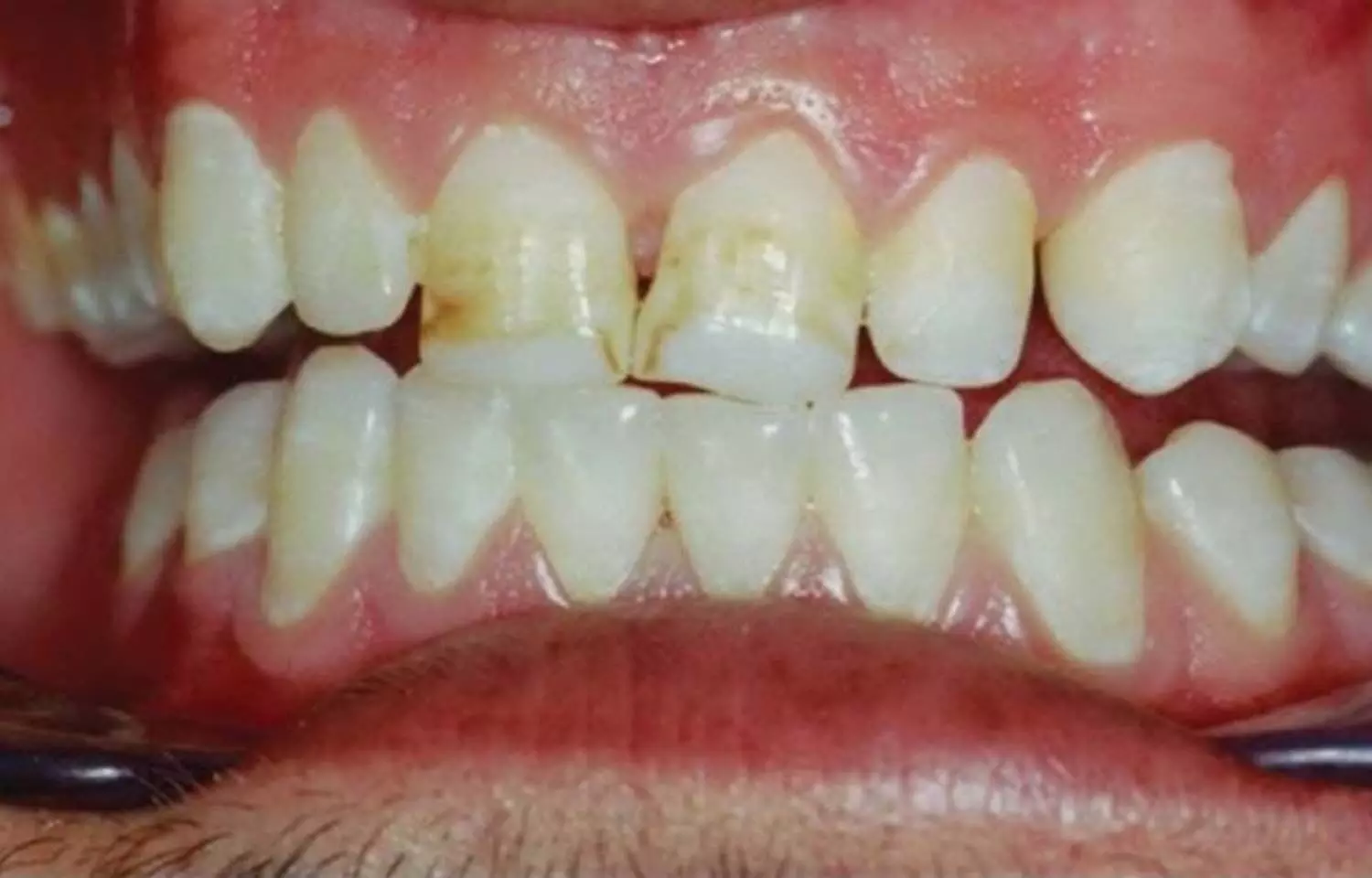 Oral bacterial community changes tied to severe dental fluorosis, Study says