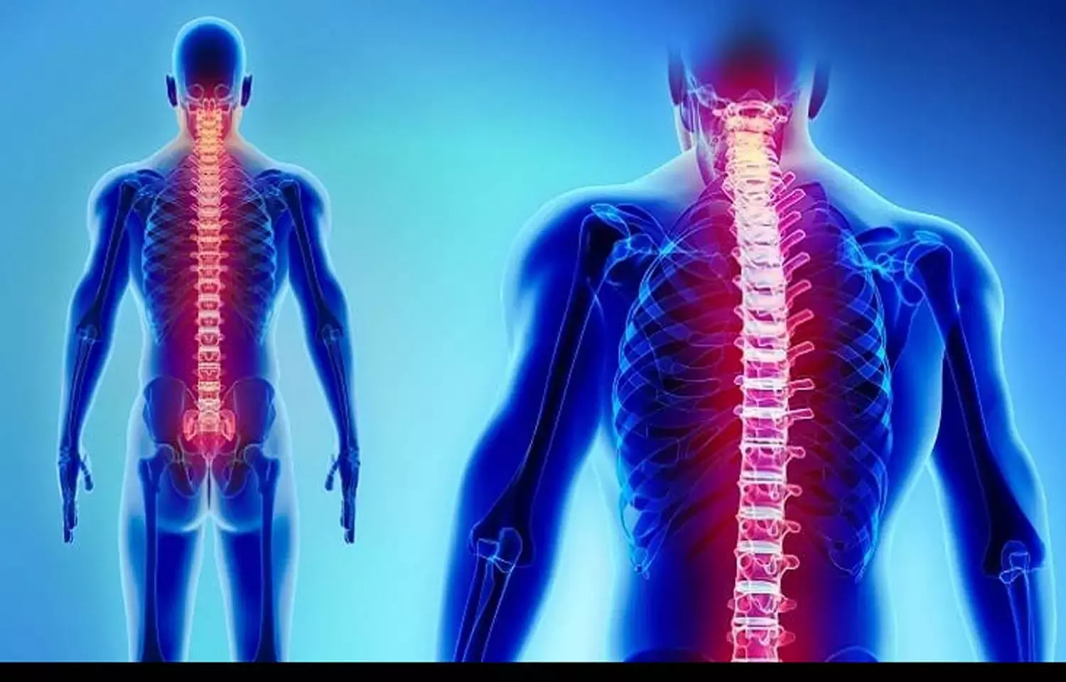 Epidural steroid injections dont increase postoperative complications of spine surgery : Study