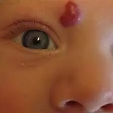 Topical Timolol safe but has limited benefit in Infantile hemangiomas: JAMA