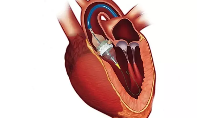 Early hypoattenuated leaflet thickening after TAVR not tied to mortality, stroke: JACC